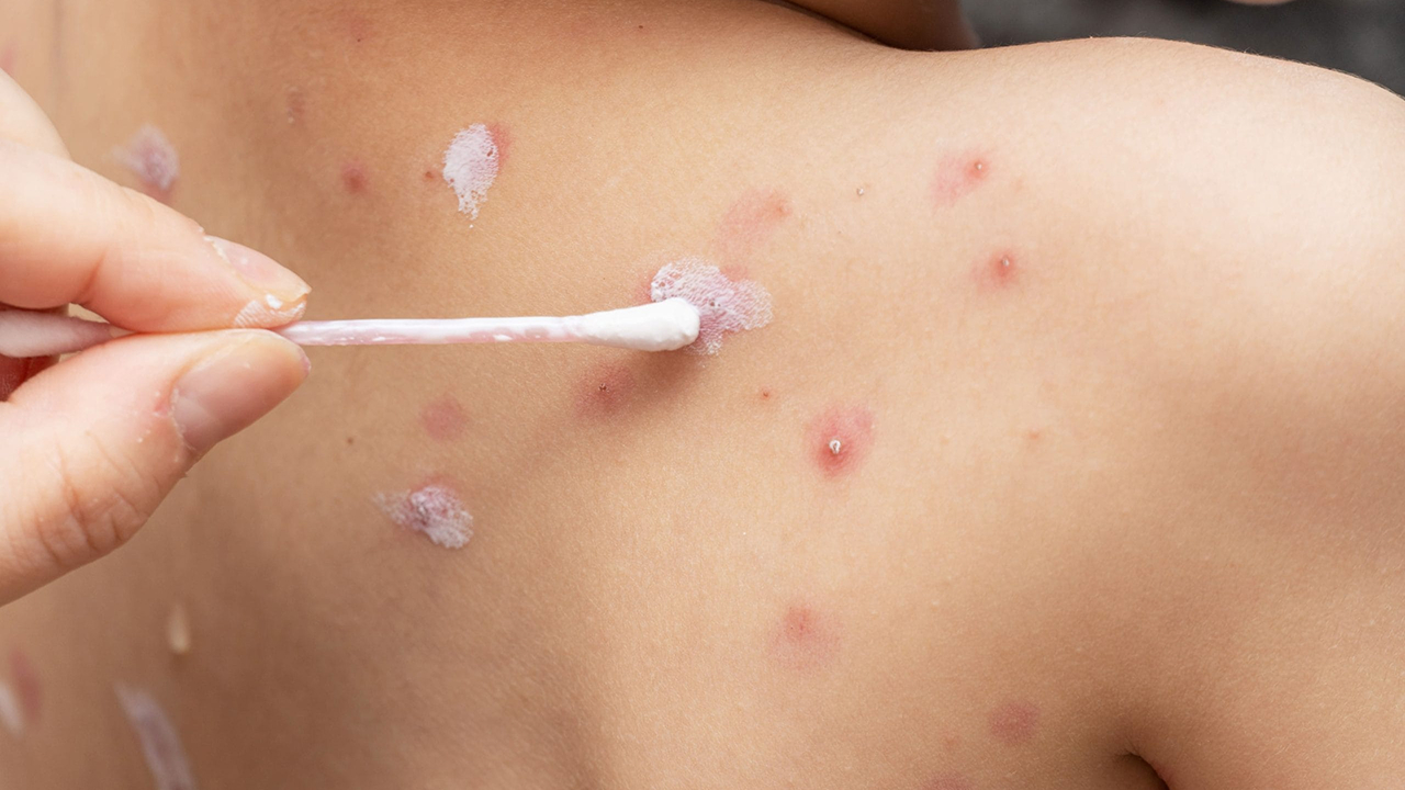 seorang anak penderita cacar air yang sedang diobati