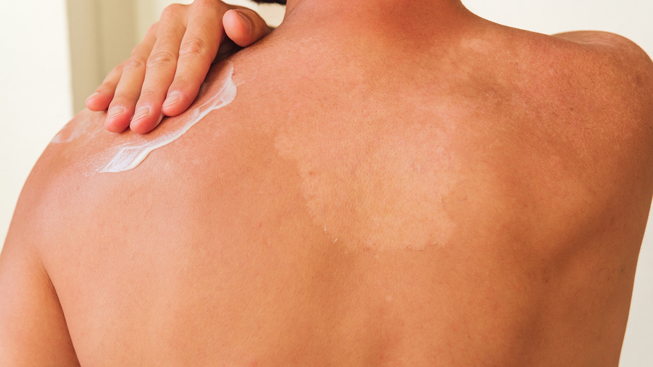 wanita mengoleskan salep ke pundak