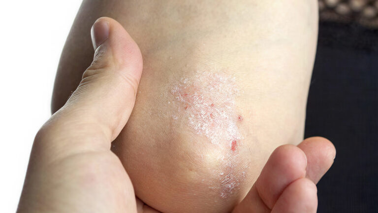 Psoriasis