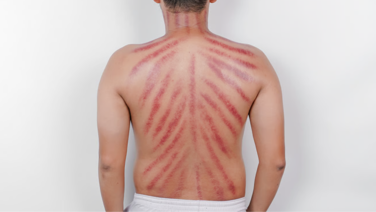 Back view of a man showing multiple red streaks and marks across his back and shoulders after a traditional scraping therapy treatment